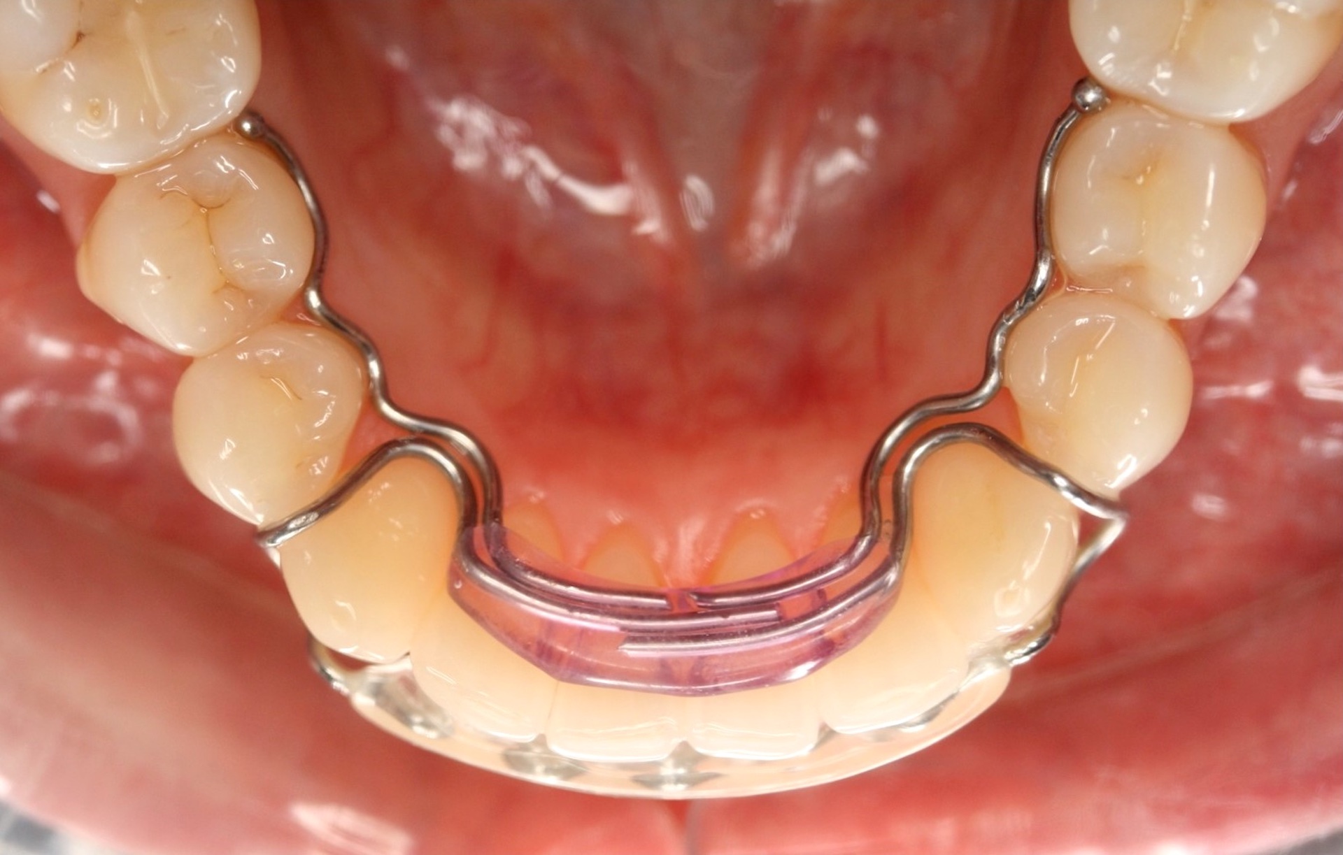 Retenedores Dentales Descubre Cu nto Tiempo Debes Usarlos Para 